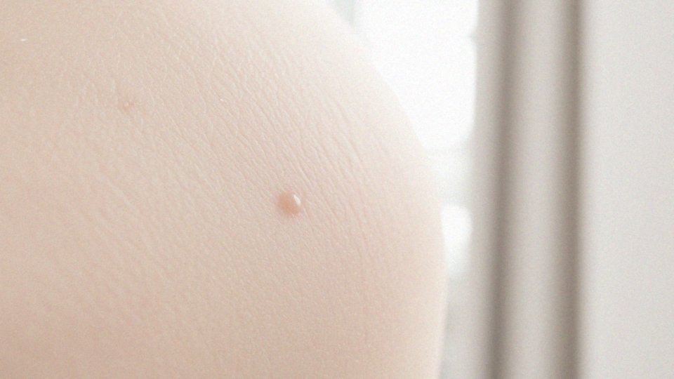 Jakie są efekty po zabiegu laserowego usuwania blizn?